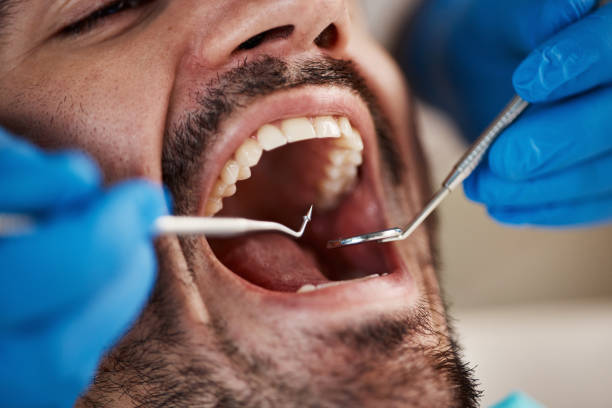 Best Emergency Wisdom Tooth Extraction in Powder Springs, GA