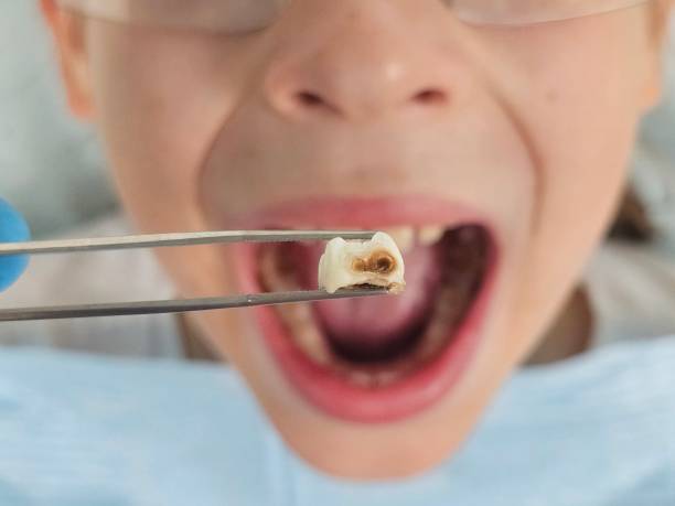 Best Emergency Treatment for Oral Infections in Powder Springs, GA